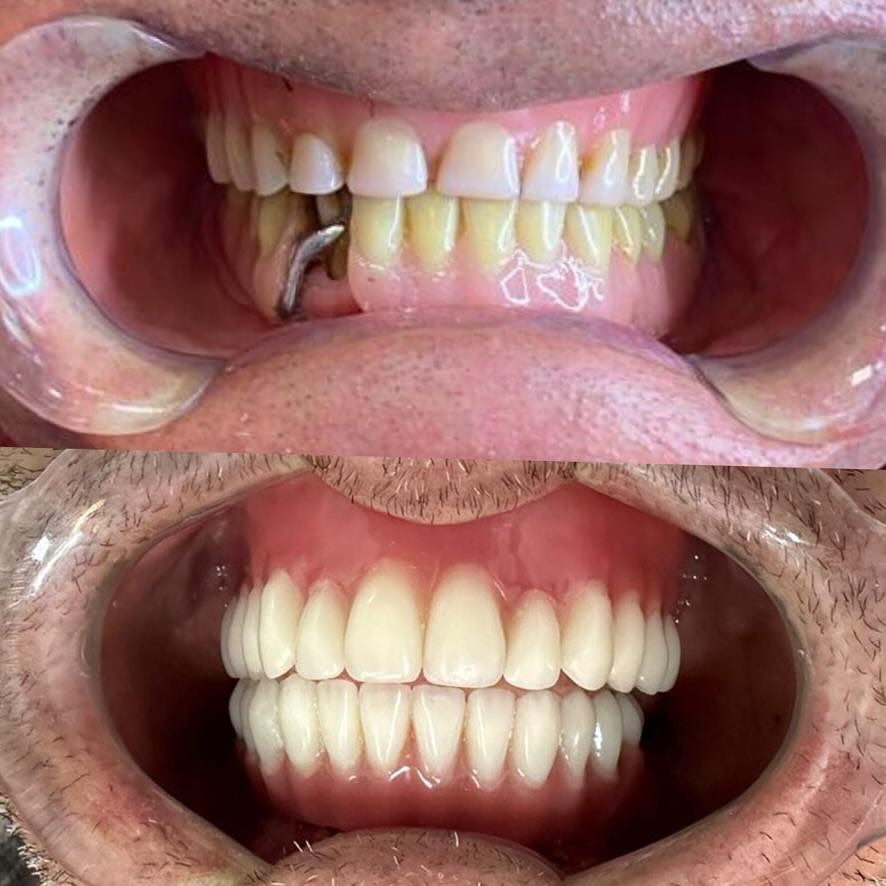 Resultado de paciente — antes e depois